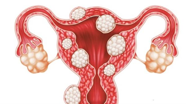ما لا تعرفينه عن الأورام الليفية في الرحم.. استشاري يوضح