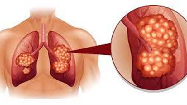 سرطان الرئة أكثر السرطانات فتكا في العالم.. لماذا؟