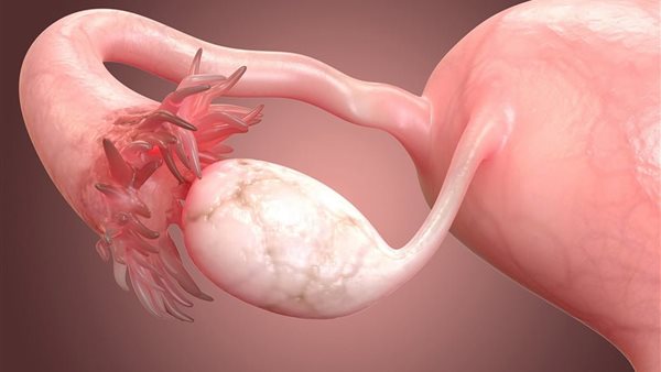 استخدام آلية جديدة في علاج سرطان المبيض.. وهذه نتيجتها